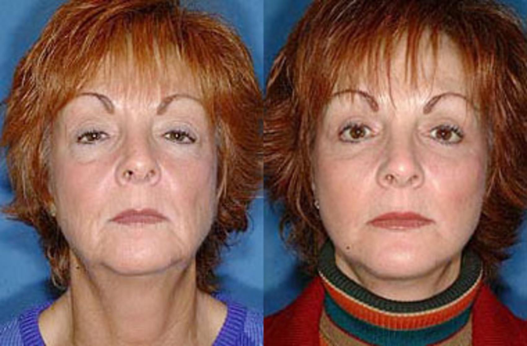facelift results