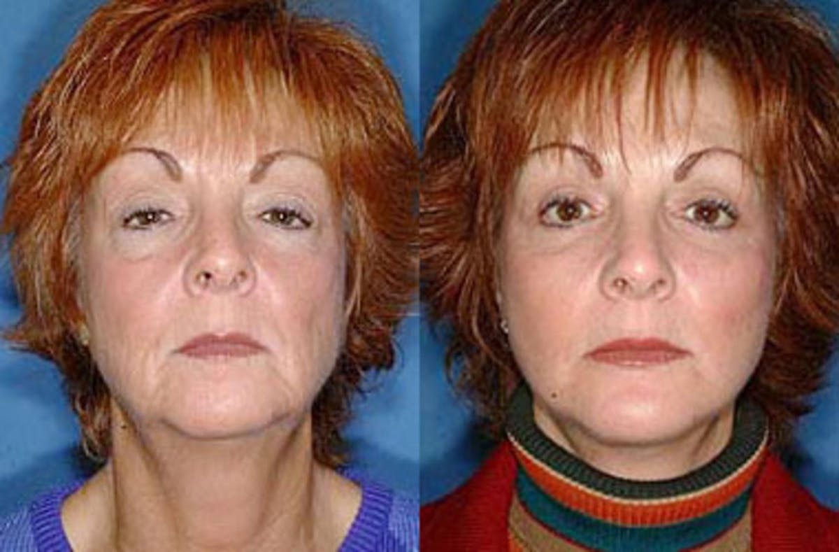 Facelift Before & After Gallery - Patient 189890 - Image 1