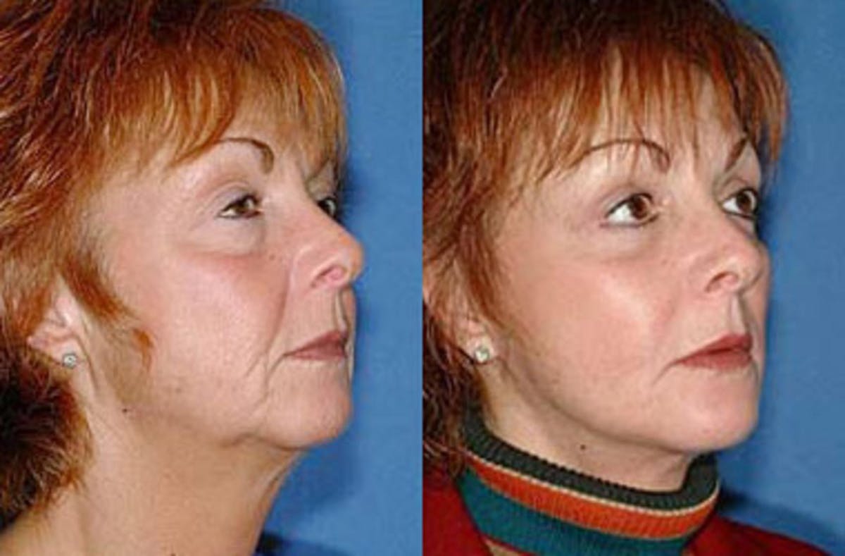 Facelift Before & After Gallery - Patient 189890 - Image 2