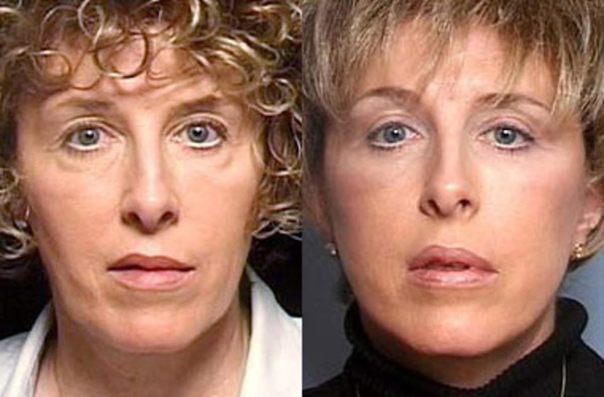 Facelift Before & After Gallery - Patient 290785 - Image 1