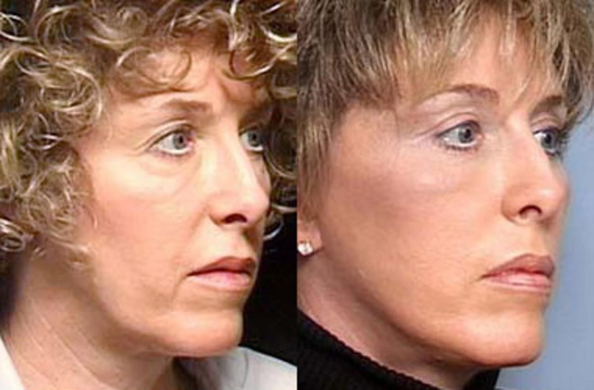 Facelift Before & After Gallery - Patient 290785 - Image 2
