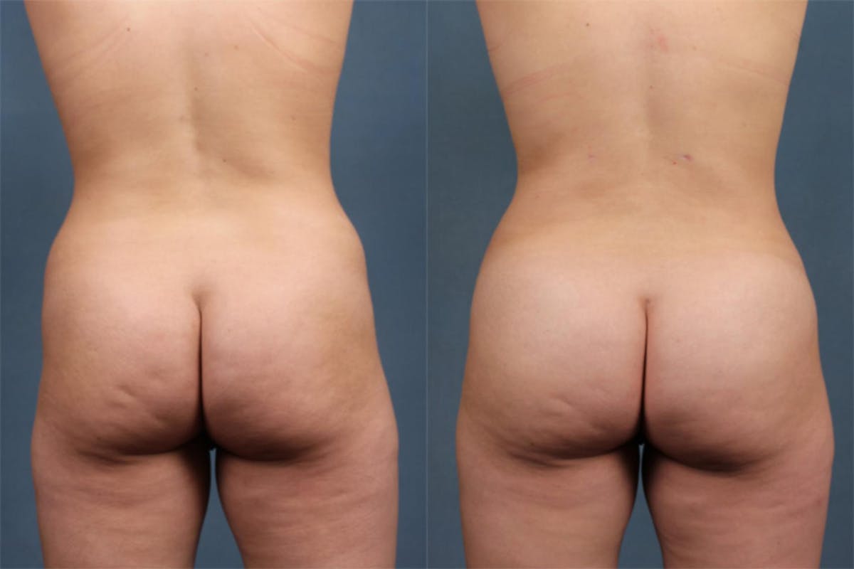 Fat Transfer Before & After Gallery - Patient 292595 - Image 1