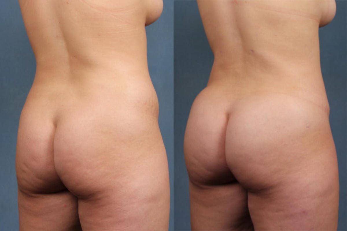 Fat Transfer Before & After Gallery - Patient 292595 - Image 2