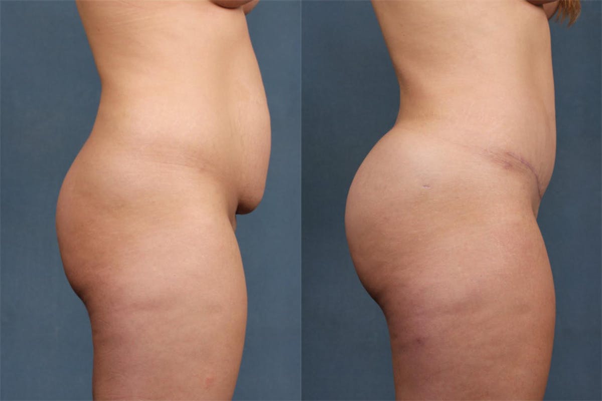 Fat Transfer Before & After Gallery - Patient 292595 - Image 3