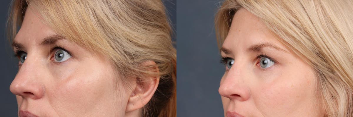 Fat Transfer Before & After Gallery - Patient 468219 - Image 2