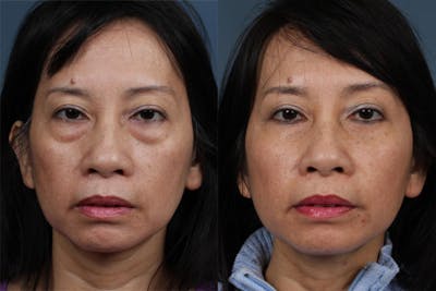 Fat Transfer Before & After Gallery - Patient 247199 - Image 1