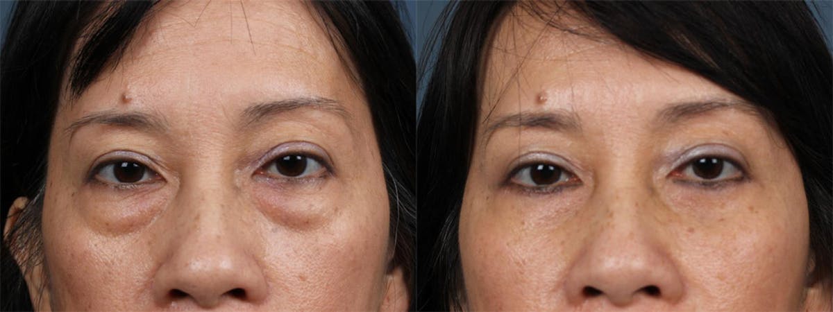 Fat Transfer Before & After Gallery - Patient 247199 - Image 2