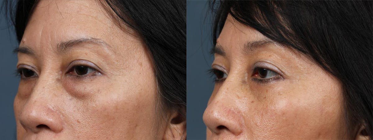 Fat Transfer Before & After Gallery - Patient 247199 - Image 3