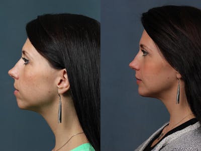 Fat Transfer Before & After Gallery - Patient 219738 - Image 1