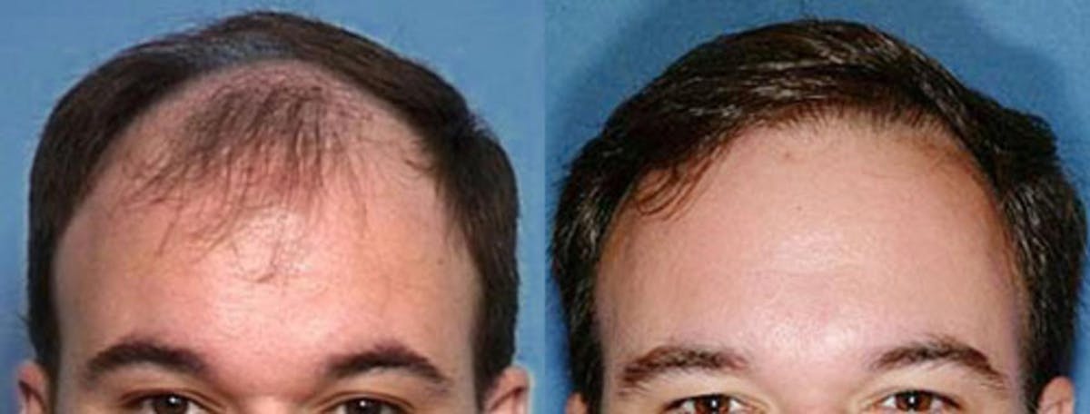 Hair Transplant Before & After Gallery - Patient 154573 - Image 1