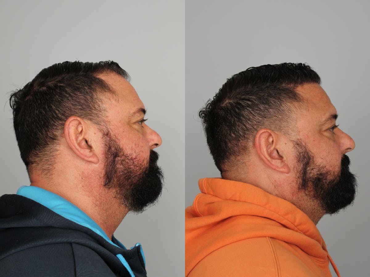 Hair Transplant Before & After Gallery - Patient 319680 - Image 2