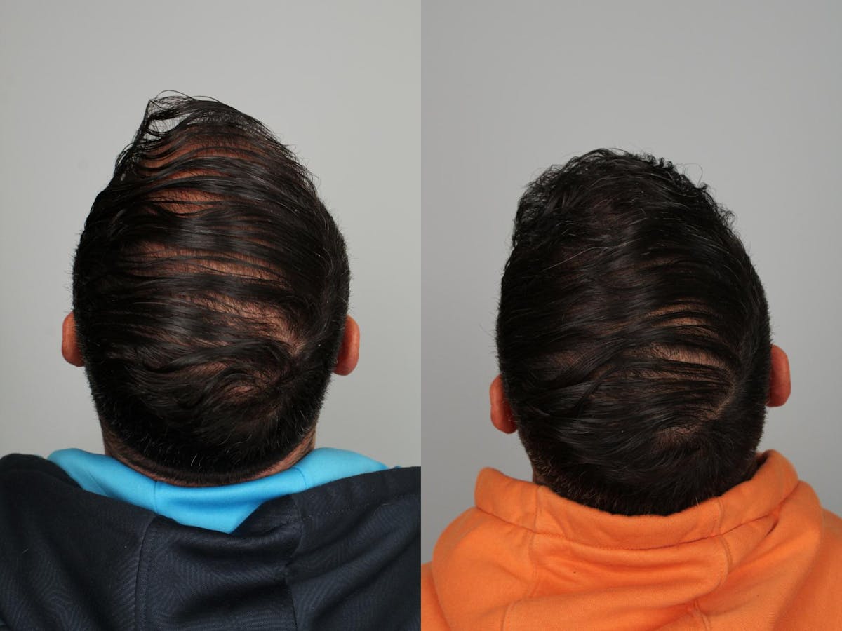 Hair Transplant Before & After Gallery - Patient 319680 - Image 3