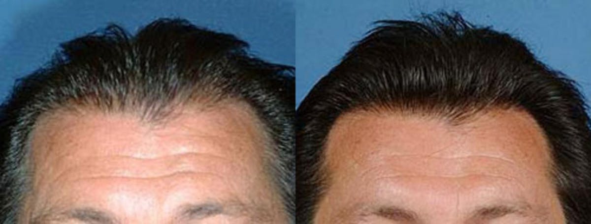Hair Transplant Before & After Gallery - Patient 380424 - Image 1