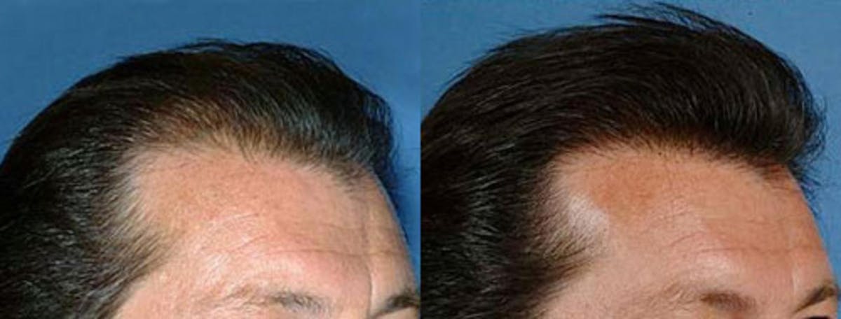 Hair Transplant Before & After Gallery - Patient 380424 - Image 2