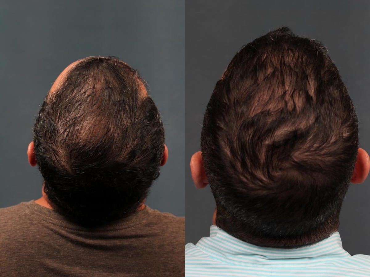 Hair Transplant Before & After Gallery - Patient 133159 - Image 1