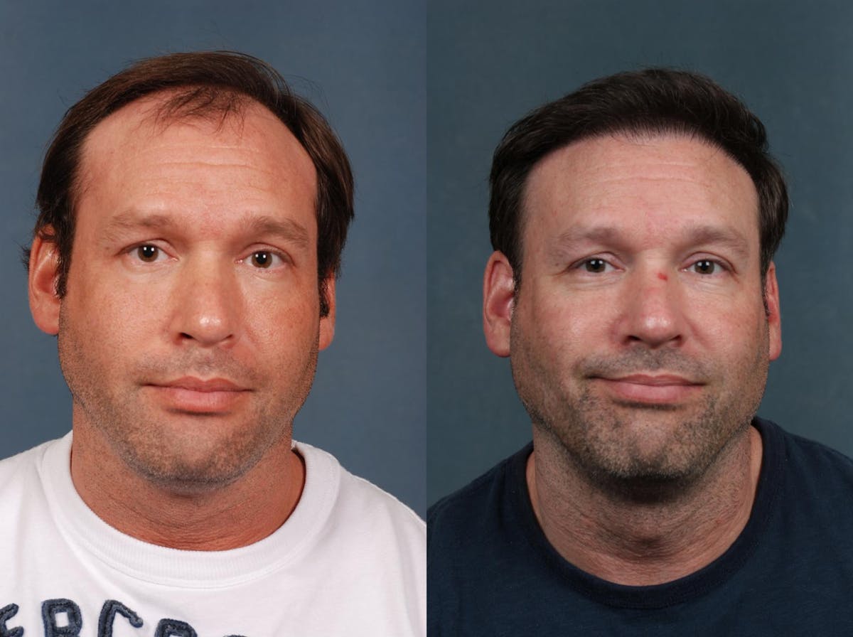 Hair Transplant Before & After Gallery - Patient 253300 - Image 1