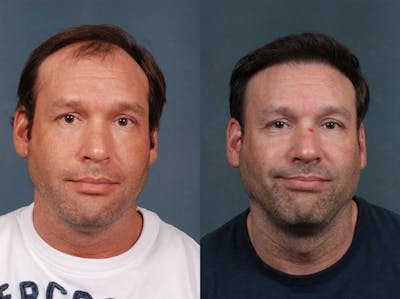 Hair Transplant Before & After Gallery - Patient 253300 - Image 1