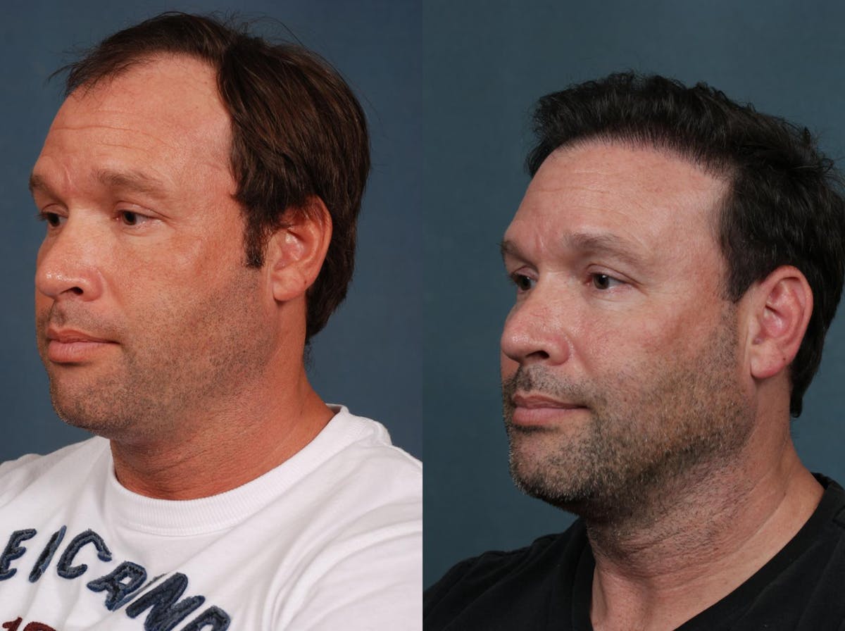 Hair Transplant Before & After Gallery - Patient 253300 - Image 2