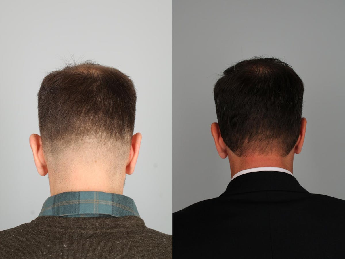 NeoGraft Hair Transplant Before & After Gallery - Patient 325138 - Image 2