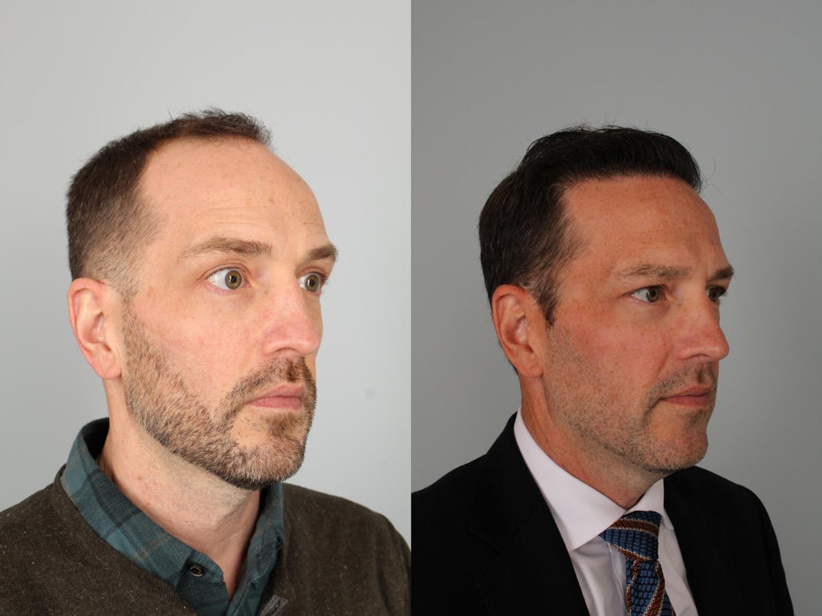 NeoGraft Hair Transplant Before & After Gallery - Patient 325138 - Image 3
