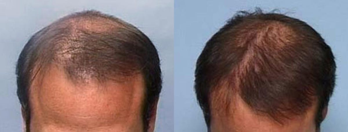 Hair Transplant Before & After Gallery - Patient 578238 - Image 1