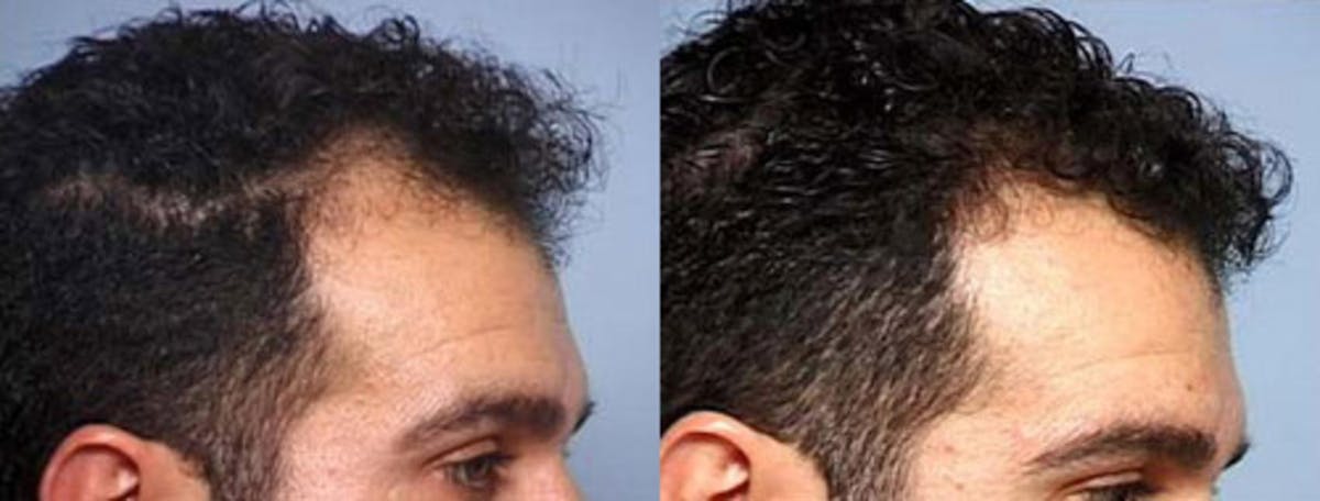 Hair Transplant Before & After Gallery - Patient 227031 - Image 1