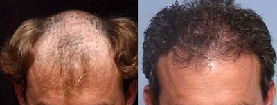 Hair Transplant Before & After Gallery - Patient 252198 - Image 1