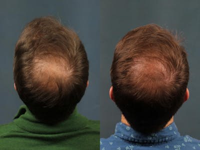 Hair Transplant Before & After Gallery - Patient 866663 - Image 1