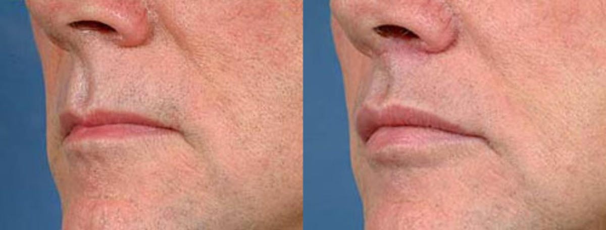Lip Lift Before & After Gallery - Patient 180158 - Image 2