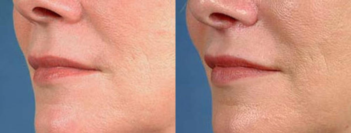 Lip Lift Before & After Gallery - Patient 973579 - Image 1