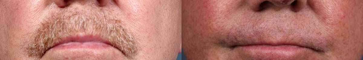 Lip Lift Before & After Gallery - Patient 428761 - Image 1