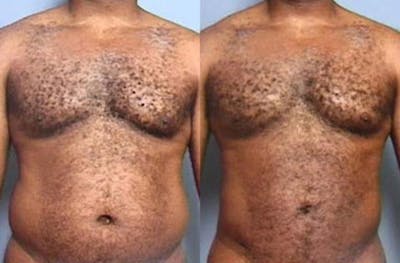 Liposuction for Men Before & After Gallery - Patient 301180 - Image 1