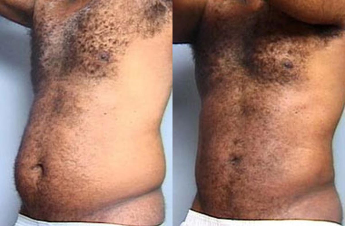 Liposuction for Men Before & After Gallery - Patient 301180 - Image 2
