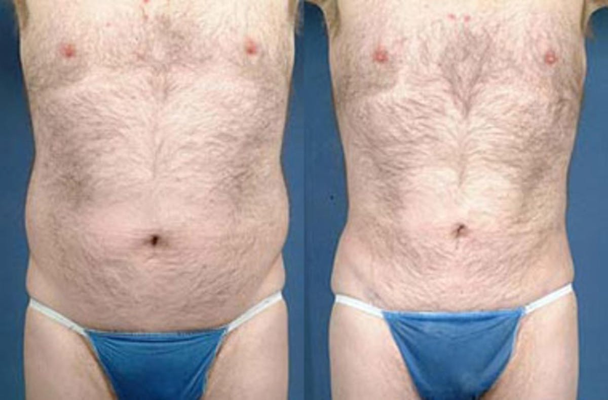 Liposuction for Men Before & After Gallery - Patient 330344 - Image 1