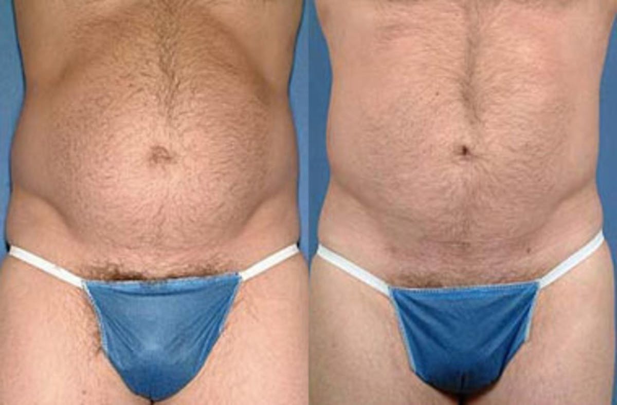 Liposuction for Men Before & After Gallery - Patient 317229 - Image 1