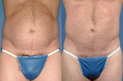 Liposuction for Men Before & After Gallery - Patient 317229 - Image 1
