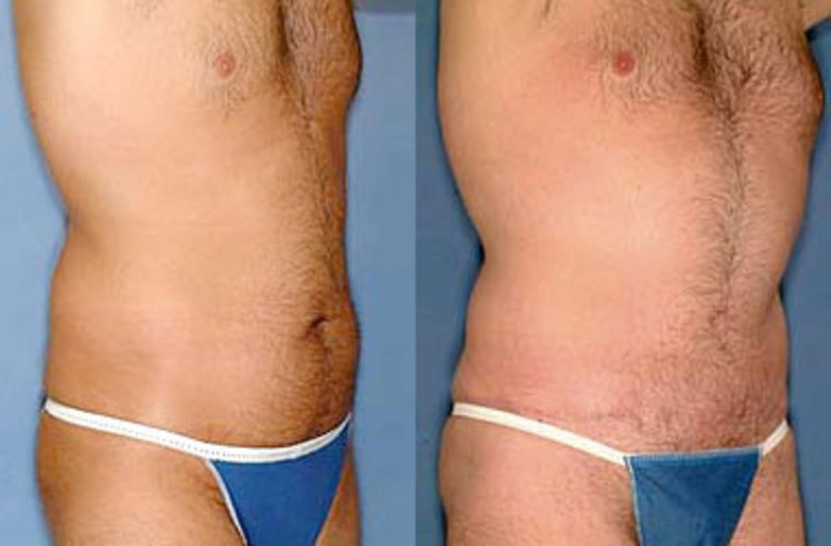 Liposuction for Men Before & After Gallery - Patient 116406 - Image 2