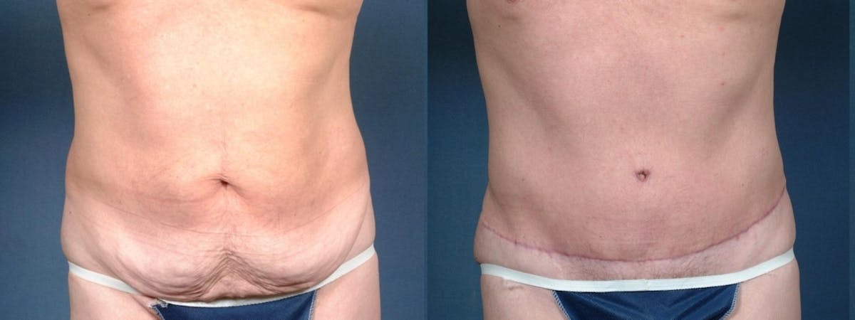 Liposuction for Men Before & After Gallery - Patient 221714 - Image 1