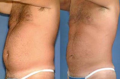 Liposuction for Men Before & After Gallery - Patient 248411 - Image 1