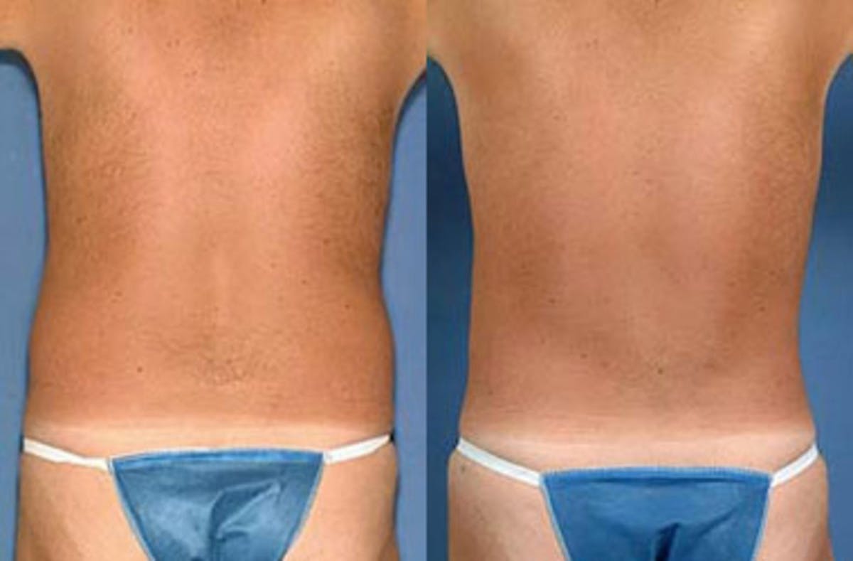 Liposuction for Men Before & After Gallery - Patient 248411 - Image 2