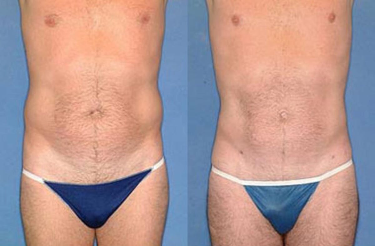 Liposuction for Men Before & After Gallery - Patient 180467 - Image 1