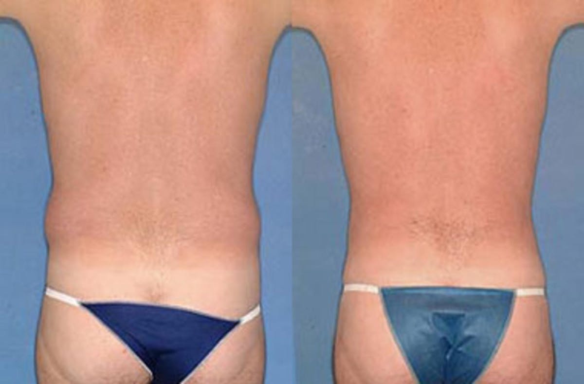 Liposuction for Men Before & After Gallery - Patient 180467 - Image 2