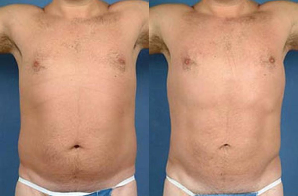 Liposuction for Men Before & After Gallery - Patient 425018 - Image 2