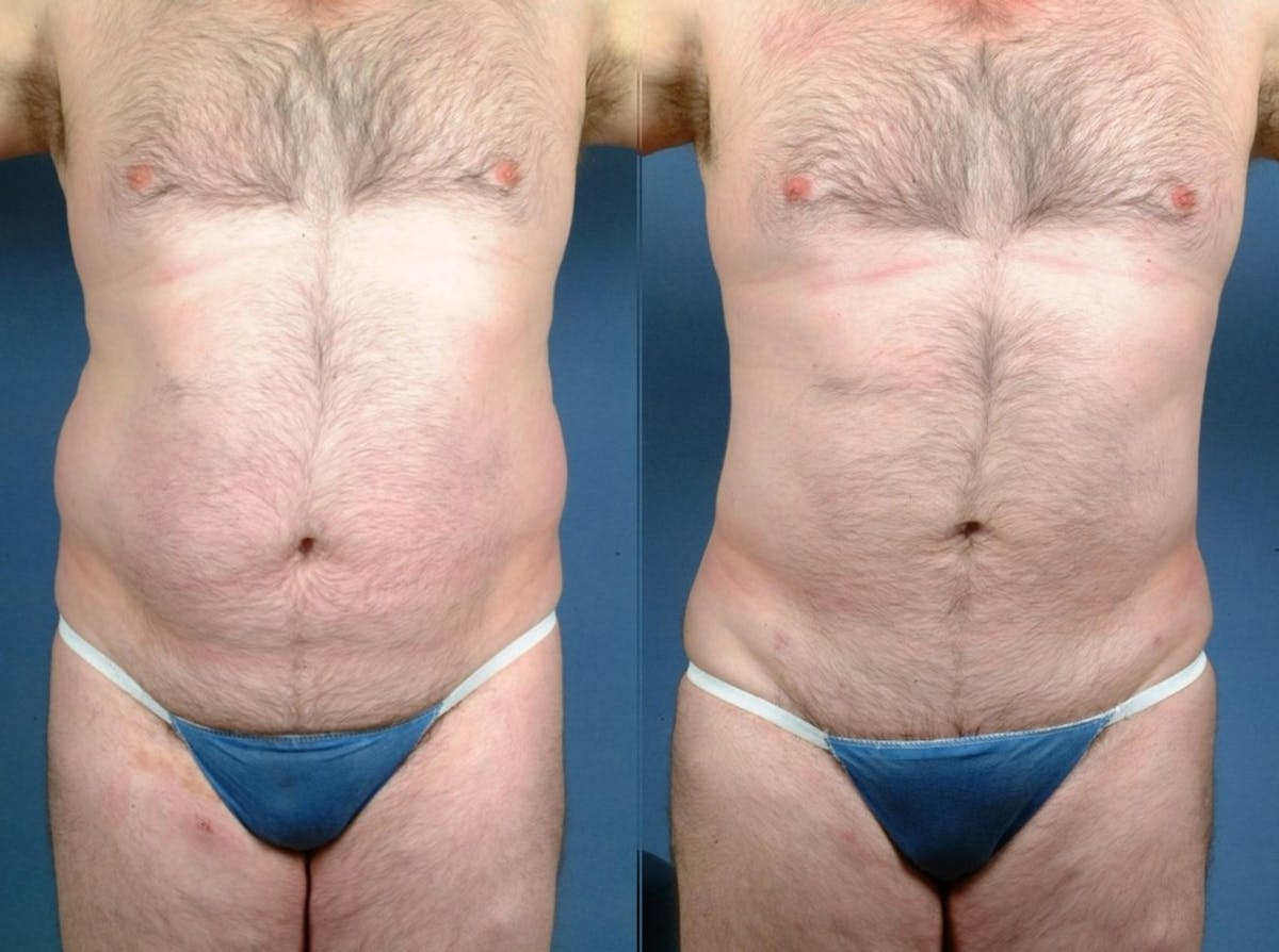 Liposuction for Men Before & After Gallery - Patient 309025 - Image 1