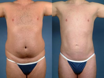 Liposuction for Men Before & After Gallery - Patient 153085 - Image 1