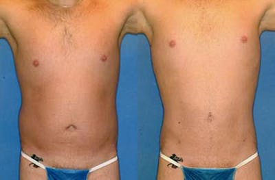 Liposuction for Men Before & After Gallery - Patient 196057 - Image 1