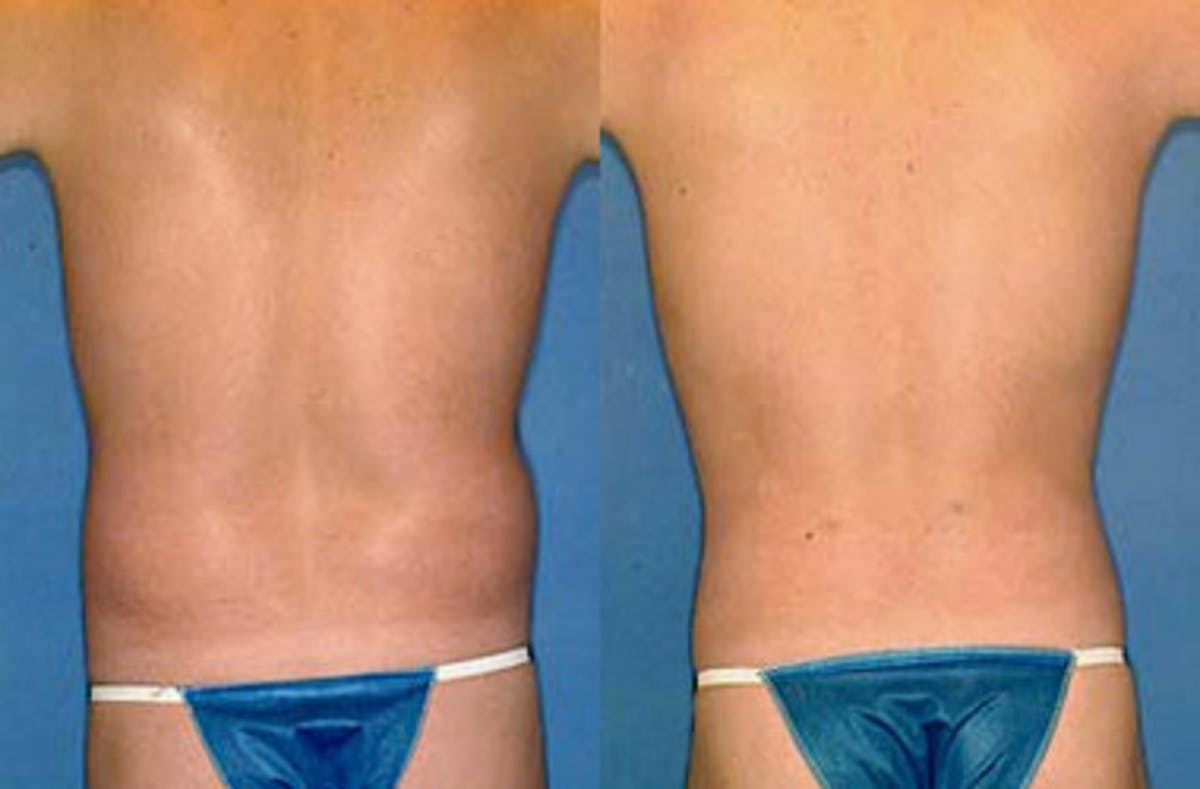 Liposuction for Men Before & After Gallery - Patient 196057 - Image 2