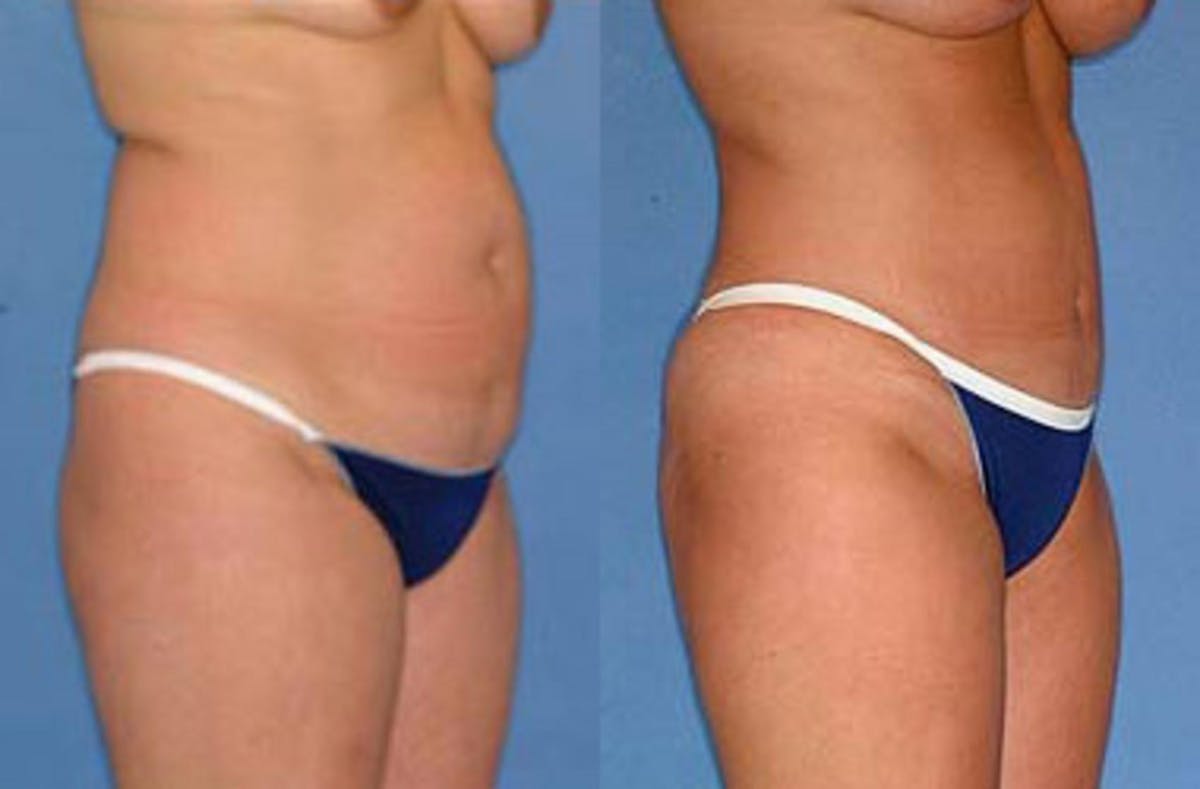 Liposuction for Women Before & After Gallery - Patient 355957 - Image 1