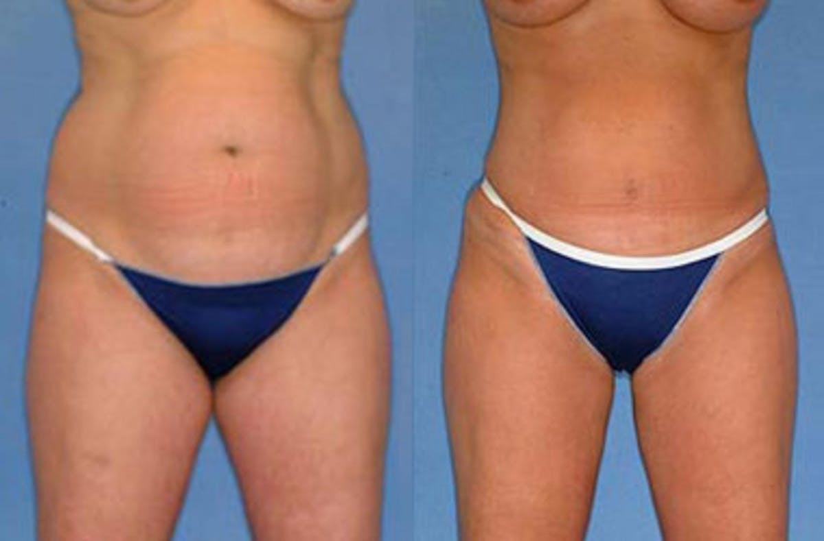 Liposuction for Women Before & After Gallery - Patient 355957 - Image 2