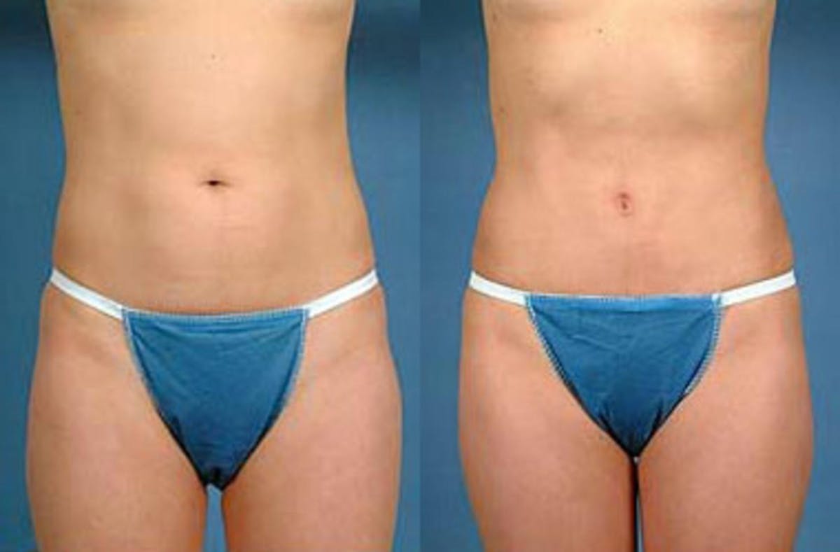 Liposuction for Women Before & After Gallery - Patient 416337 - Image 1